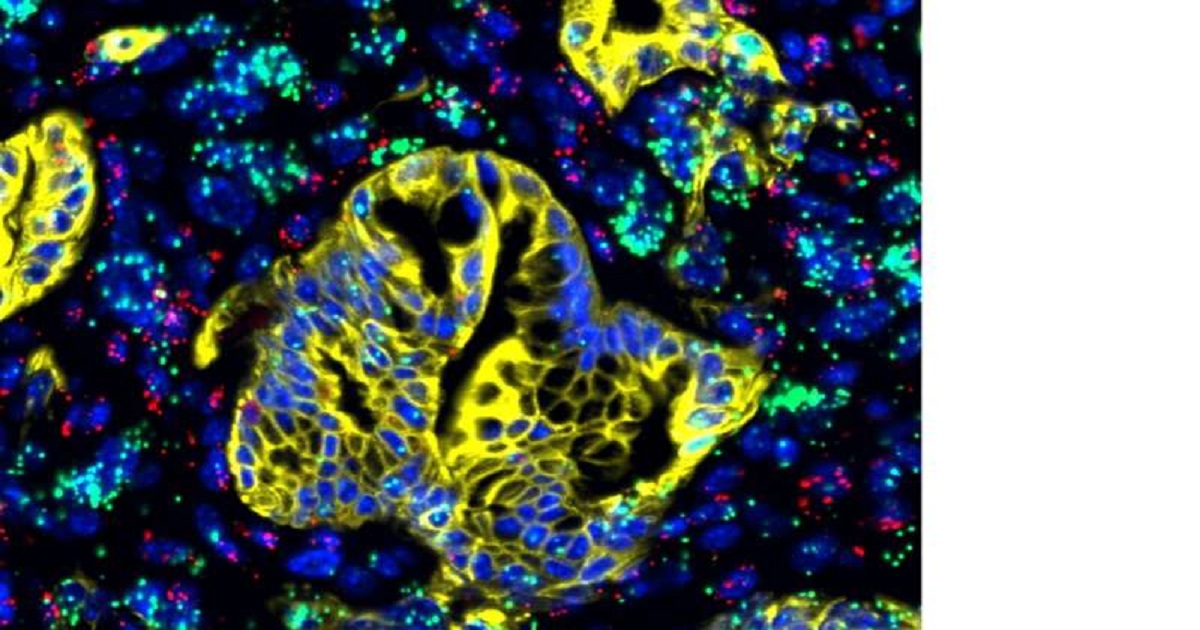 New study targets Achilles' heel of pancreatic cancer, with promising results