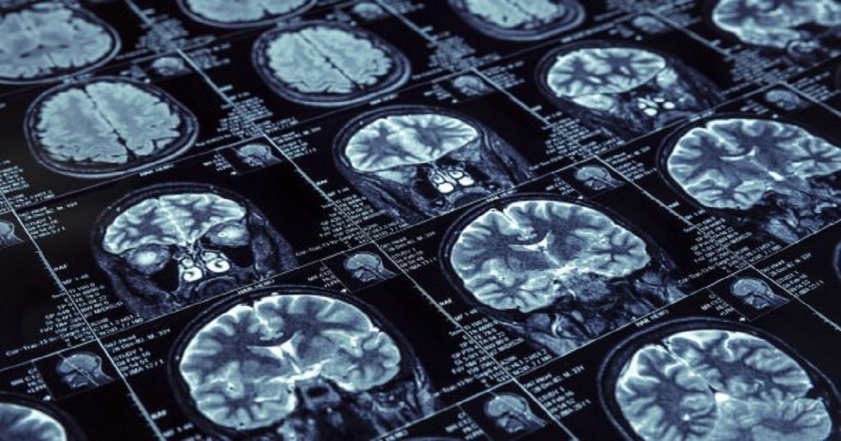 Bayer’s regorafenib kicks off brain cancer platform trial